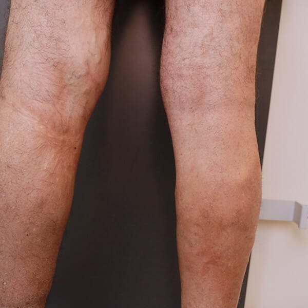 varicose veins laser treatment before and after patient 1