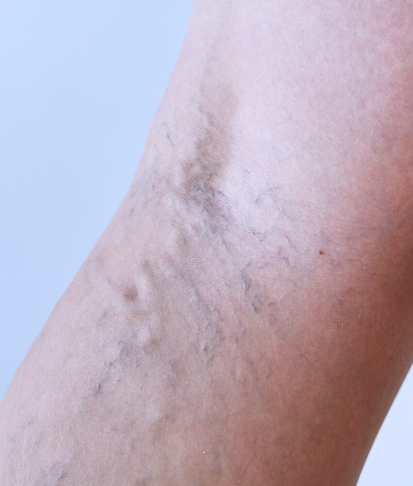 Varicose vein removal - vein glue treatment
